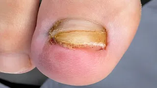 😢Ele já arrancou a unha duas vezes. Aprenda a cortar para crescer corretamente #nails