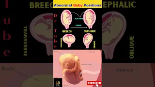 Understanding Abnormal Baby Positions Pregnancy Positions Baby Position In Womb Shortsfeed 