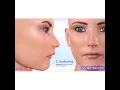 Download Lagu Dilin yanlış pozisyonlandırılması sonucu oluşan anomalinin ortodontik tedavisi‼️