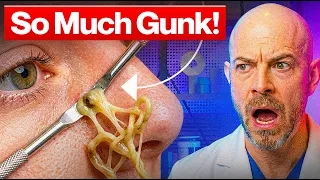 Dermatologist Reacts: The Pimple That NEVER Ends!