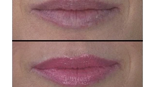 Quick Fix for Lip Wrinkles