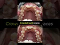 Crowded teeth braces transformation 36 months time