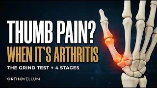 Thumb Base Arthritis The Price of the Human Grip
