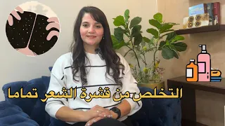التخلص من قشرة الشعر تماما    روشته علي الماشي دندنها