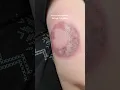 Download Lagu the day I got the tattoo and then 7 laser tattoo removal sessions later. tattoo update!