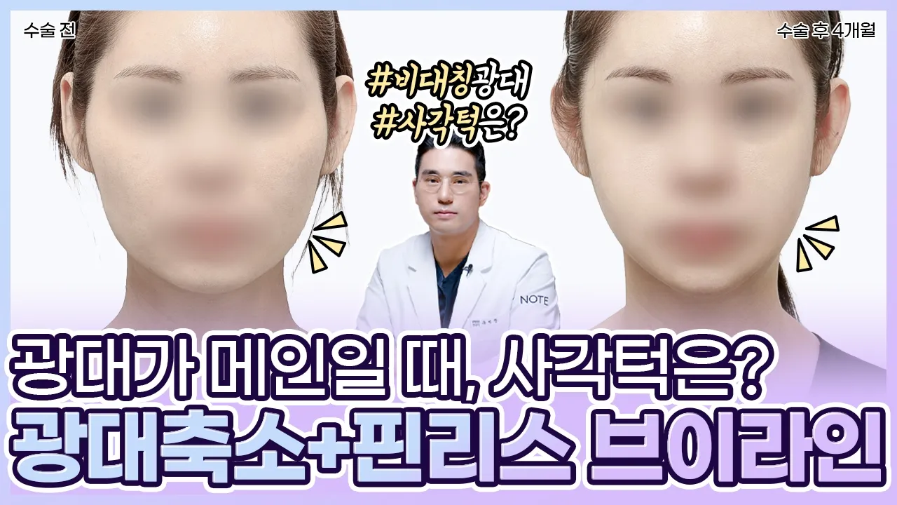 [유.케.리] 📍 CT로 보는 케이스 리뷰 l 비대칭 윤곽 l 광대만? vs 사각턱도? l 40대 윤곽수술l
