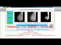 Breast Cancer Detection Using Matlab Breast Cancer Prediction Using Image Processing Project Code