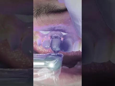 Deep anterior tooth cavity #dentist composite veneer