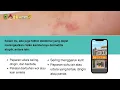 Download Lagu Dermatitis Atopik