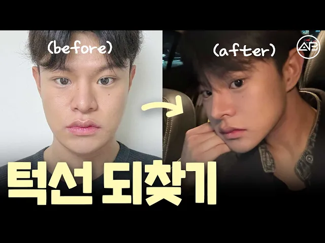 잃어버린 턱선을 되찾았어요 | 에이비성형외과