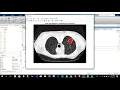 Lung Cancer Detection on CT Scan Images in MATLAB
