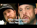 What happened to Gold Rush star Rick Ness face
