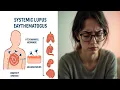 Systemic Lupus Erythematosus