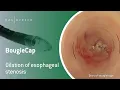 Download Lagu BougieCap | Dilation of esophageal stenosis