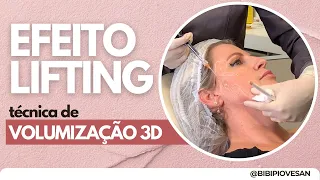 Como fazer o Efeito Lifting com Ácido Hialurônico -  Técnica de Volumização 3D
