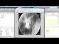 Secondary Glaucoma Diagnosis Technique IEEE 2017 Matlab Projects in Bangalore