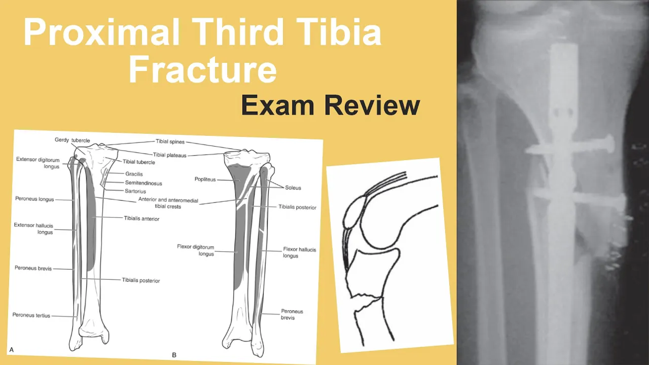 Evidence-Based Treatment of Lumbar Disc Herniations.. 