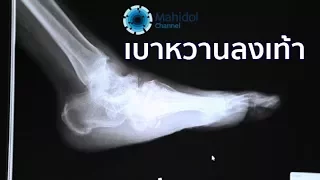 ทำไมคนที่เป็นเบาหวานถึงไม่รู้สึกเจ็บเมื่อเท้าบาดแผลหรือเหยียบเศษแก้ว