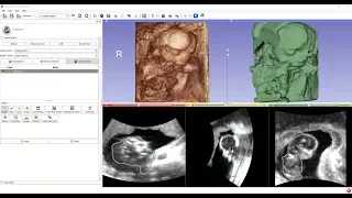 View your baby ultrasound and create 3D printable model using free software
