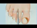 Lagu ASMR | foot Care and Ingrown toenails cleaning | @Asmranimation30