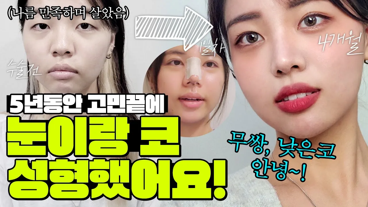 5️⃣년간의 고민 끝에 눈, 코, 이마 티 안 나게 예뻐짐❕❕ #눈매교정 #코수술 #이마지방이식