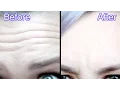 BOTOX RESULTS My First Botox Experience at Laseraway