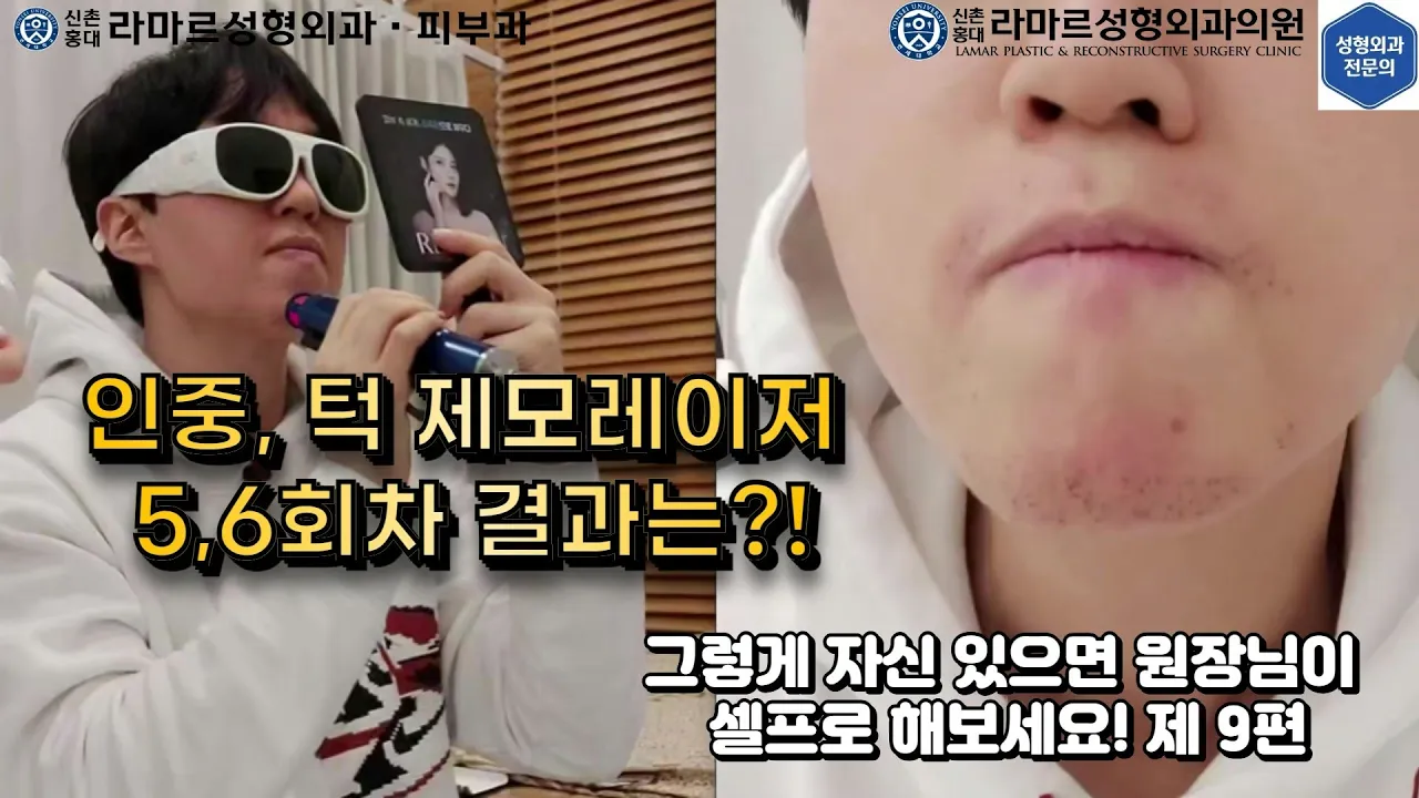 [모영웅 대표원장님 셀프시술 제9편] 인중, 아래턱 제모 5,6회차 결과 공개!