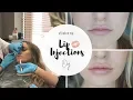 My Experience With Lip Filler Urban You Beauty Bar