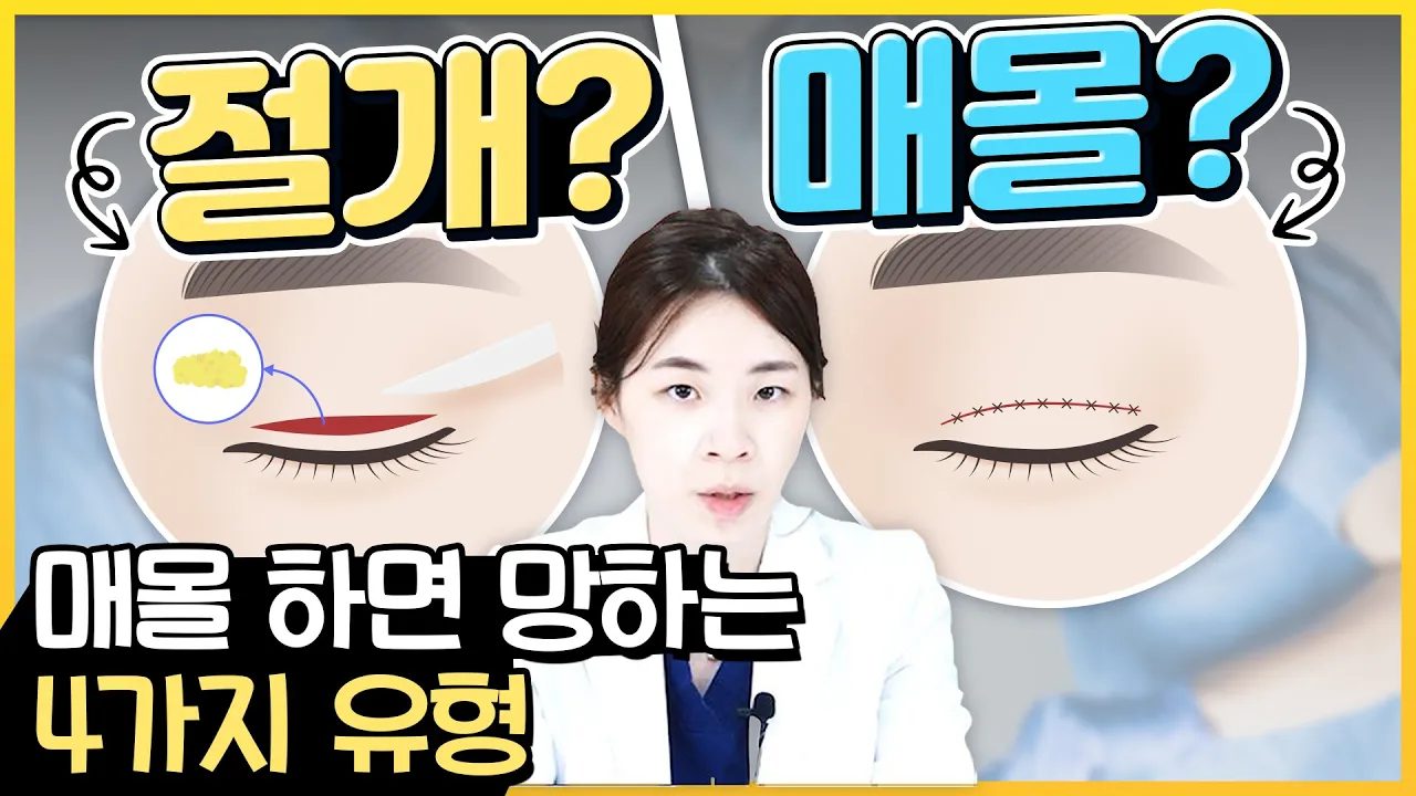 [눈 성형] 매몰하면 망하는 유형이 있다구욧?! 이런 분들은 비추합니다 !! 🤔🤔