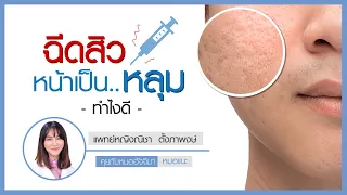 รอยบุ๋มบนผิวหนังที่เกิดจากสิวมีสาเหตุมาจากอะไรบ้าง