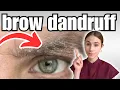 How To Get Rid Of Eyebrow Dandruff