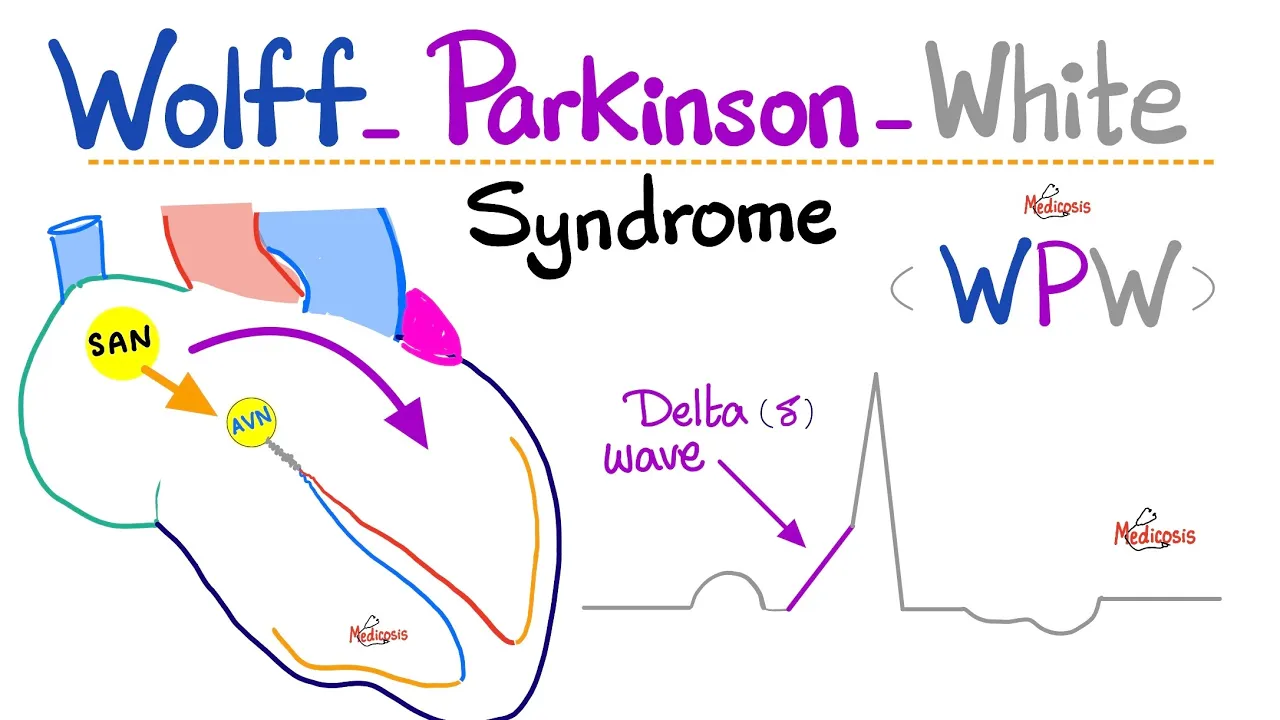 Heart Arrhythmia - Wolff-Parkinson White (WPW) Syndrome - AVRT - Supraventricular Tachycardia - ECG
