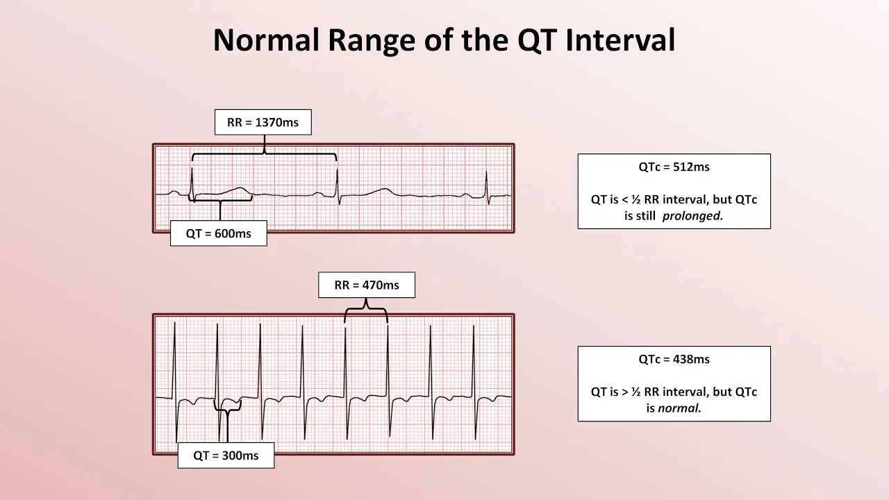 Advanced EKGs - The QT Interval and Long QT Syndrome