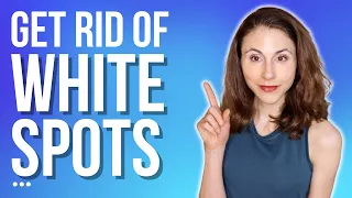 how to get rid of white spots on skin dermatologist drdrayzday