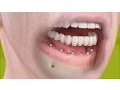 Download Lagu Straumann - Fixed restoration with 4-6 implants, all straight