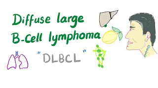 Download Diffuse Large B-Cell Lymphoma (DLBCL) | Aggressive  B-Cell Non-Hodgkin’s Lymphoma MP3