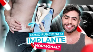 MINHA EXPERIÊNCIA com o IMPLANTE HORMONAL | SEM MENTIRAS