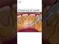 How is cleaning of teeth done at clinic