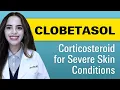 What you need to know about Clobetasol