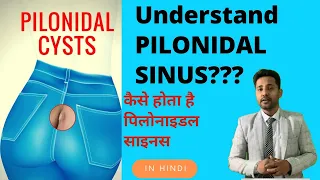 Download Pilonidal Sinus in Hindi | Pilonidal Sinus Treatment MP3