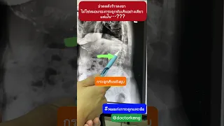  ปวดหลังรุนแรงและชาลงขา เกิดจากสาเหตุอะไร 
