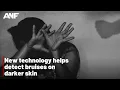 New technology helps detect bruises on darker skin