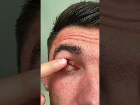 MY EYEBALL IS DEAD 😳