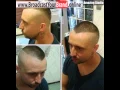 Shaved Sides Haircut For Men With Thinning Hair