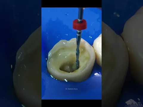 Dental nerve removal - Root Canal Treatment