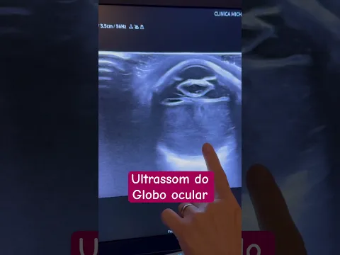 Ultrassom do olho globo ocular #ultrasound
