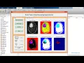 MATLAB code of Brain Tumor Detection using Segmentation