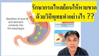 การปรับพฤติกรรมอย่างไรจึงจะช่วยรักษากรดไหลย้อนได้ดีขึ้น