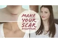 HOW TO FADE SURGERY SCARS Thyroidectomy Scar Care Graves Disease