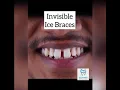 Download Lagu How braces are put on - Crystal clear braces #shorts